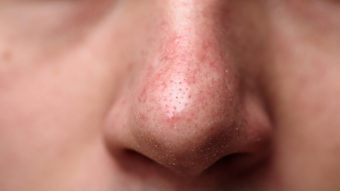 Warum Sonnenschutz bei Rosacea wichtig ist - PTAheute